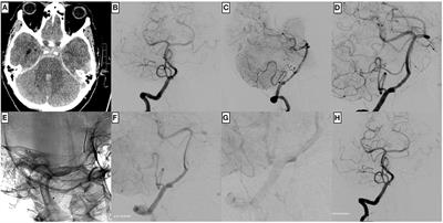 Flow Diversion for Reconstruction of Intradural Vertebral Artery Dissecting Aneurysms Causing Subarachnoid Hemorrhage—A Retrospective Study From Four Neurovascular Centers